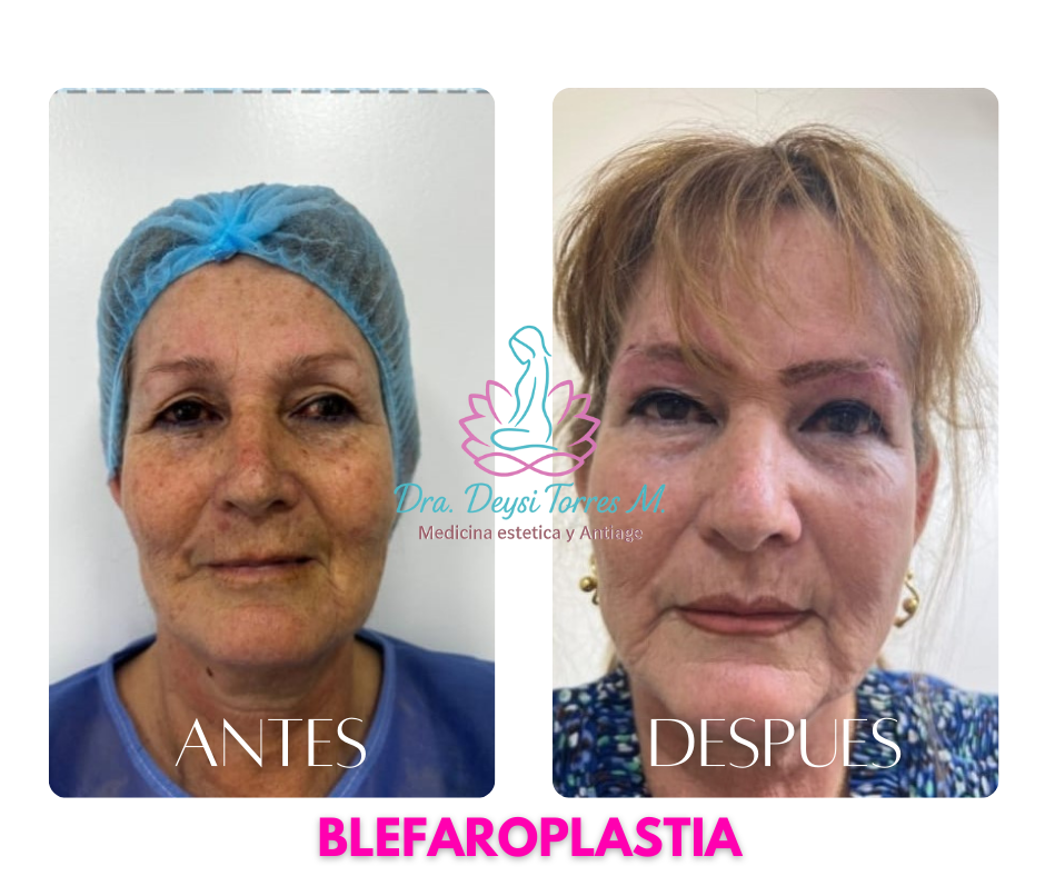 Blefaroplastia antes y despues