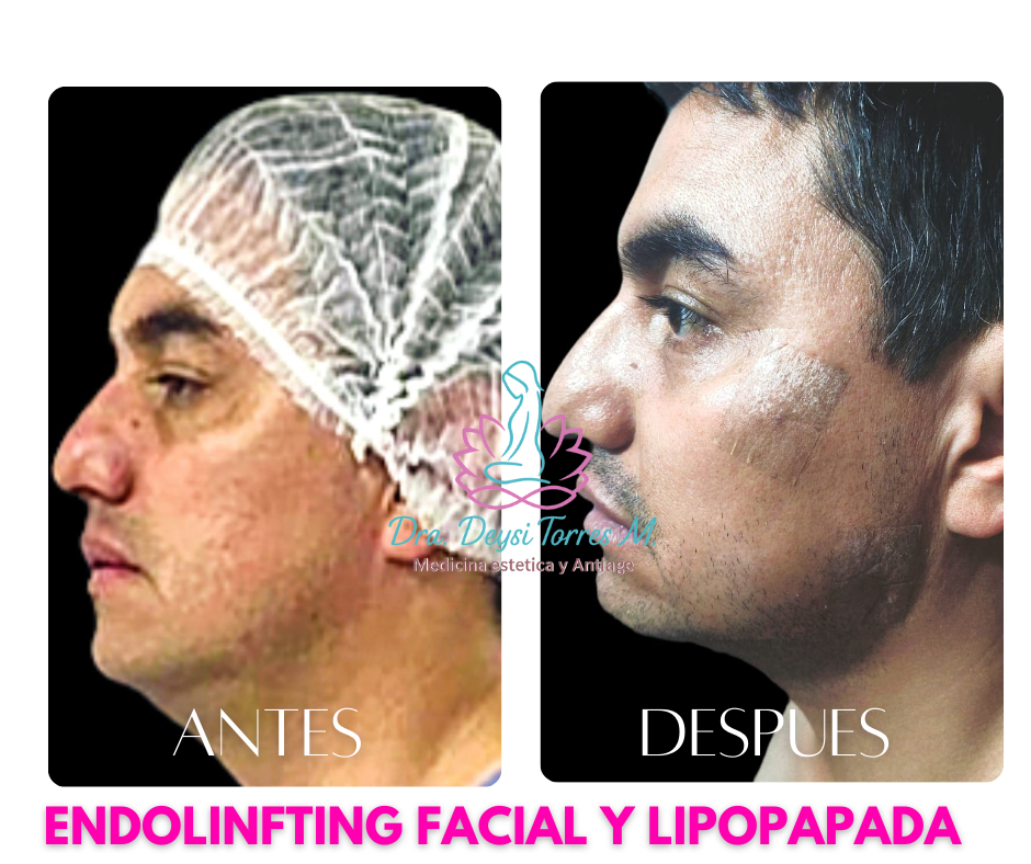 Endolinfting facial antes y despues