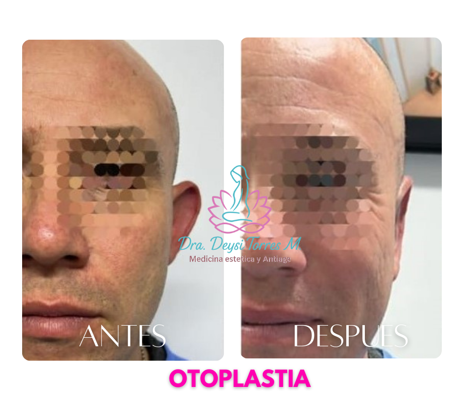 Otoplastia dra. Deysi Torres