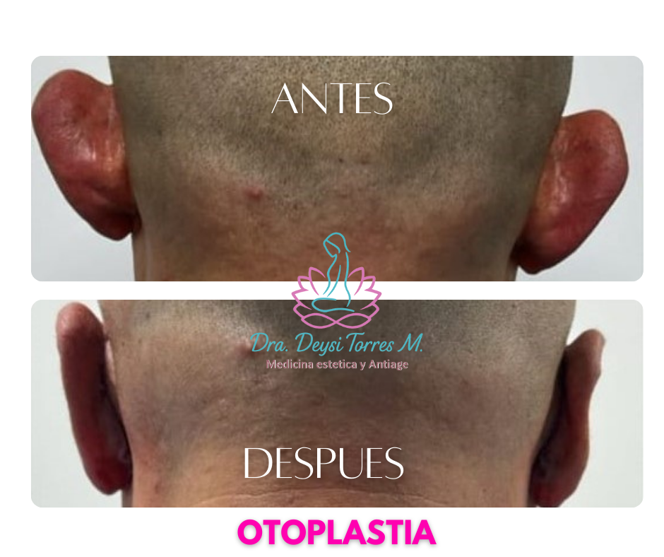 otoplastia antes y despues