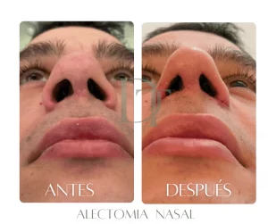 Resultados-Reales-de-Alectomía-Nasal-en-Bogotá