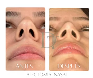 alectomia-nasal-antes-despues-bogota.