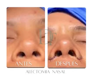 alectomia-nasal-antes-despues-bogota-dc