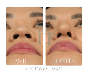 alectomia-nasal-resultado-dra-deysi-torres