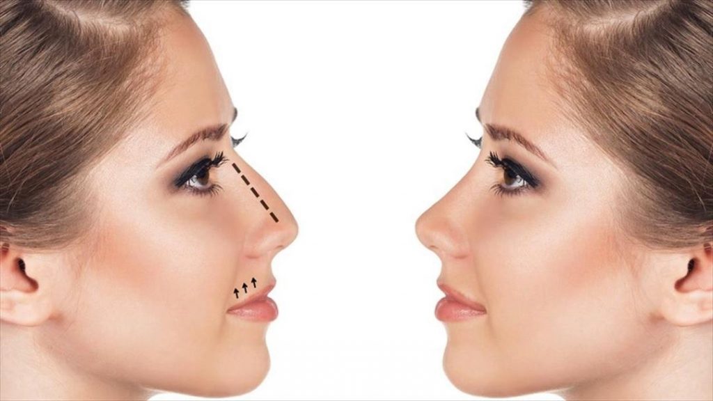 alectomia nasal vs rinoplastia