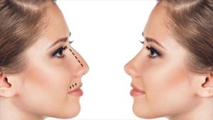 alectomia nasal vs rinoplastia