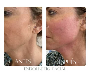 endolifting-bogota-antes-despues-cuello