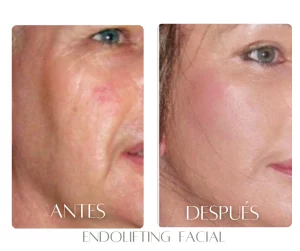 endolifting-bogota-antes-despues-facial
