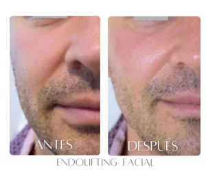 endolifting-bogota-antes-despues-mandibula