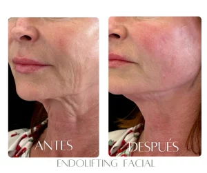 endolifting-bogota-antes-despues-ovalo