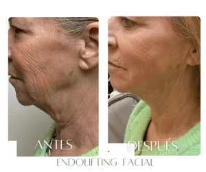 endolifting-bogota-dc-antes-despues-mandibula