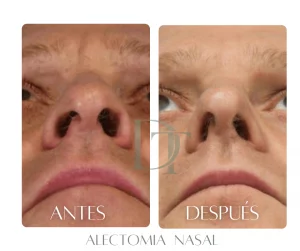reduccion-alas-nasales-antes-despues-bogota
