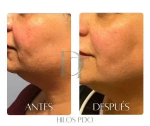 hilos-pdo-bogota-antes-despues-cuello-dra-deysi-torres
