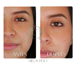 hilos-pdo-bogota-antes-despues-ovalo-facial-dra-deysi-torres