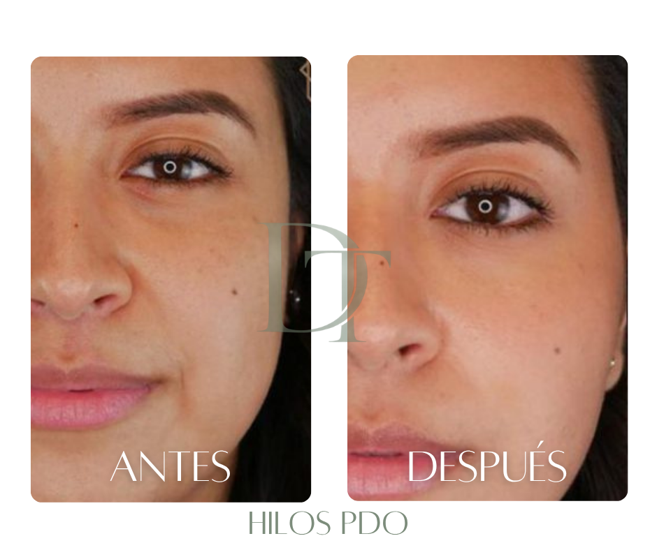 hilos-pdo-bogota-antes-despues-ovalo-facial-dra-deysi-torres