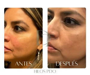 lifting-hilos-pdo-bogota-resultado-natural-dra-deysi-torres